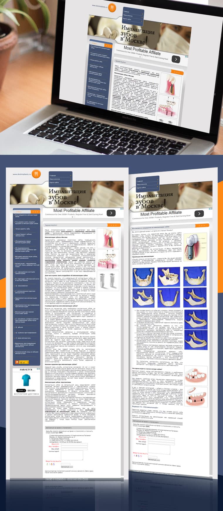 TEETH IMPLANTATION IN MOSCOW - Կայքի ձևավորում և պատրաստում